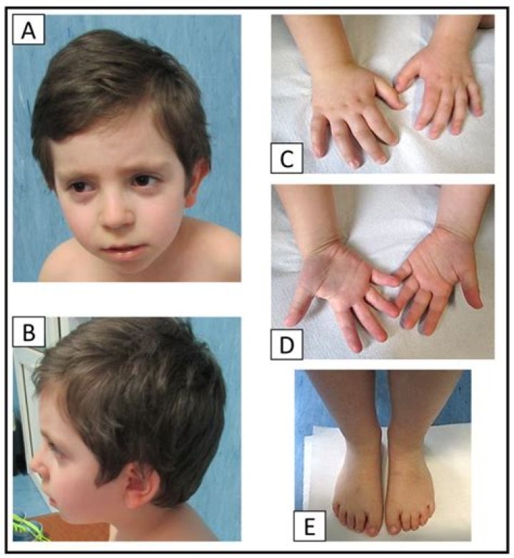 About Davon Wade, Whose Sister Sustained Microdeletion Syndrome