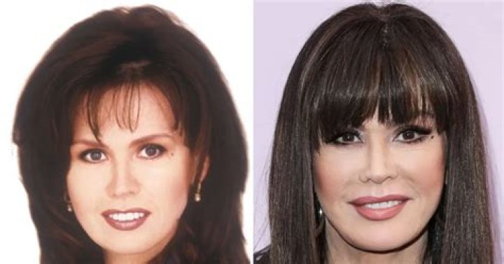 Marie Osmond Facelift And Plastic Surgery Before And After Pics, Age And Height